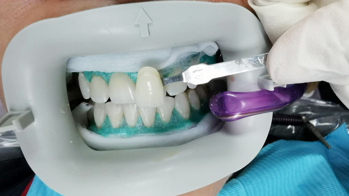 ortodoncia-y-blanqueamiento-la-guinda-del-pastel